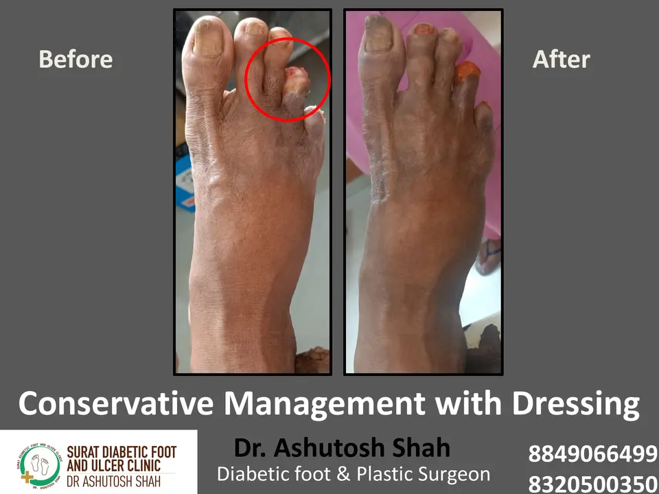 Diabetic Foot  PPT 3 checked by sir.pptx-38.webp